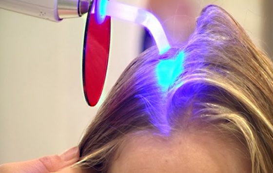 Tratamiento Láser para Alopecia