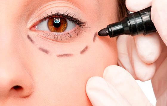 Blefaroplastia