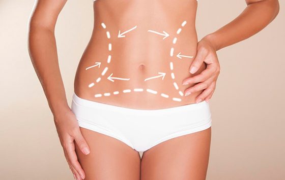 Hidrolipoclasia, la Liposucción Soft asistida con Láser